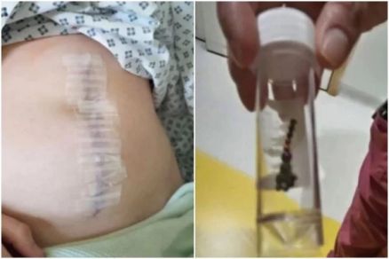 Jovem perde parte do intestino após “desafio do piercing”