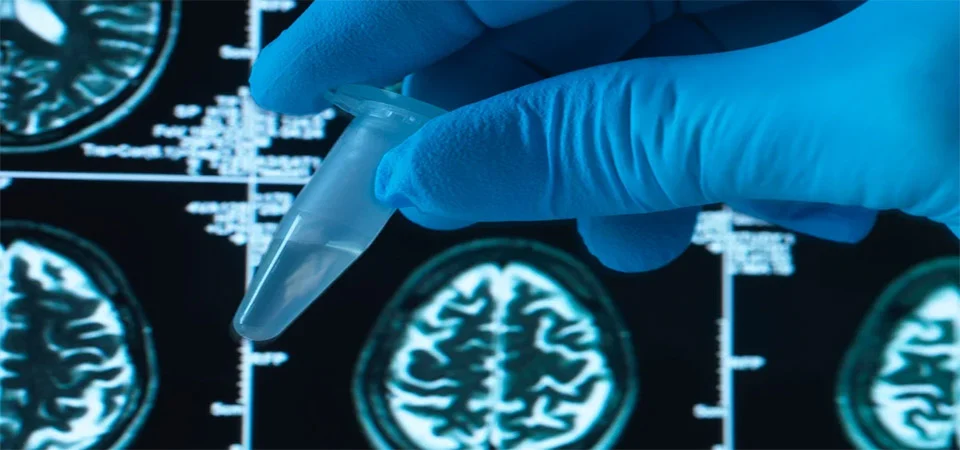 Proteína do câncer pode proteger contra o Alzheimer, sugere estudo